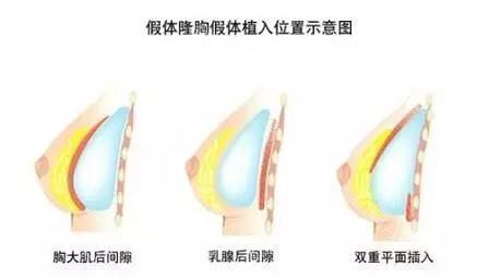 隆胸影响母乳喂养吗隆胸会导