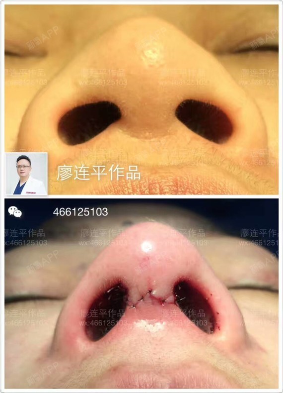 取鼻梁奥美定 全肋软骨鼻综合 肋软骨垫鼻翼基底,术后