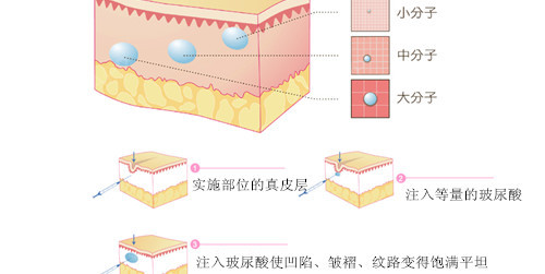 新氧 - 氧气姐 | 玻尿酸去法令纹 | 玻尿酸丰唇 | 玻尿酸 | 整形纯干货 新氧 - 氧气姐 | 玻尿酸去法令纹 | 玻尿酸丰唇 | 玻尿酸 | 整形纯干货