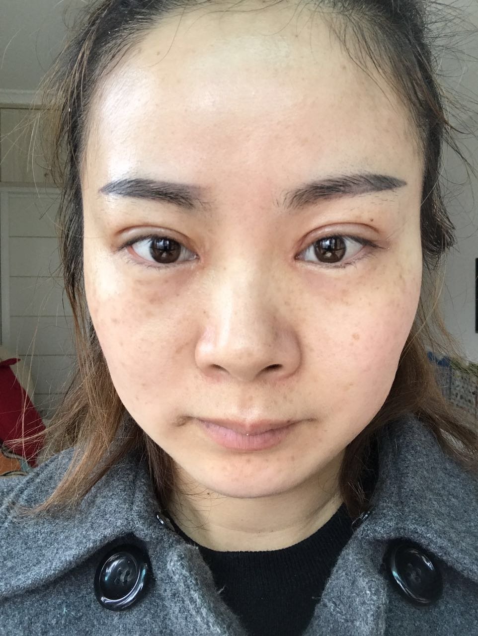 武汉新至美医疗美容激光祛斑怎么样_恢复过程_效果_飞
