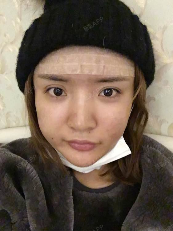 烟熏色素瑾流年自体脂肪全脸填充第30天美丽日记