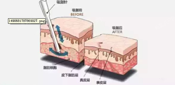 皮下如何进针图解