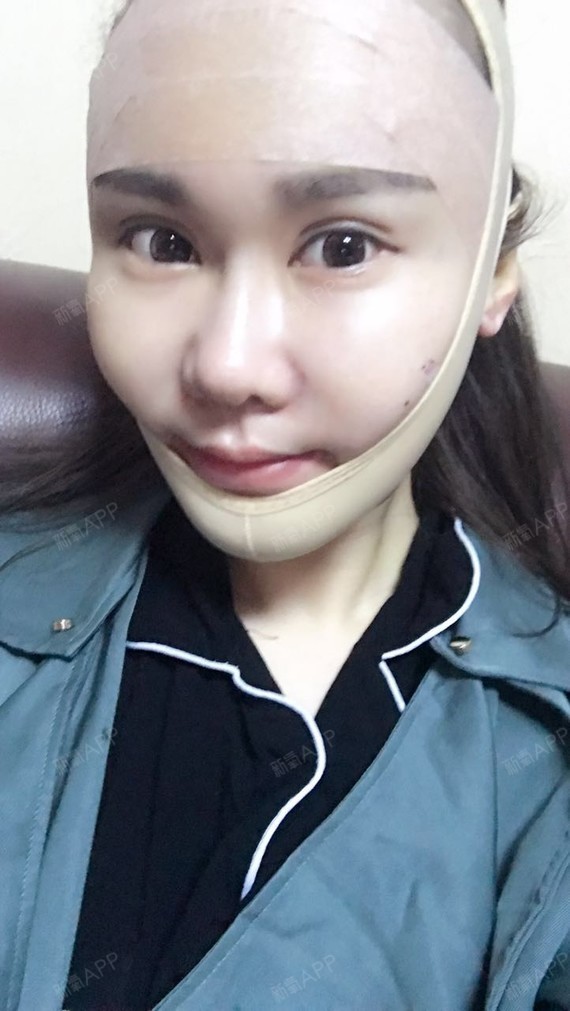 光纤溶脂瘦脸