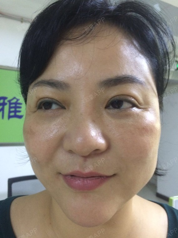 从侧面看我的颧骨突出,法令纹明显,显得整个人不够柔和,不仅显老