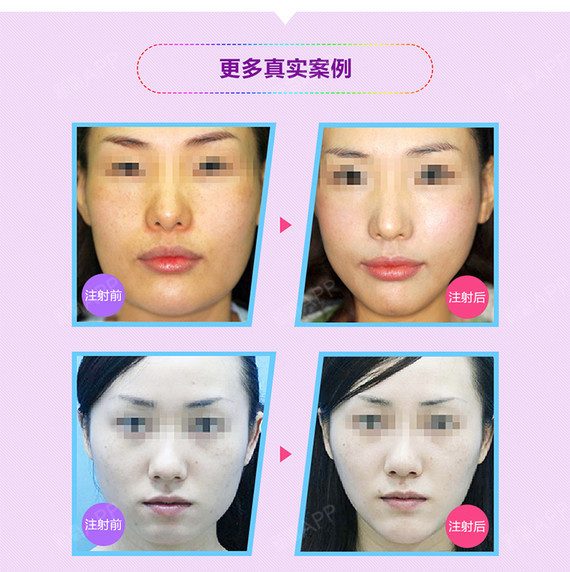 【肉毒素】进口botox 瘦脸针 打造v脸紧致提升还原青春光彩