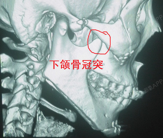 术后第38天,两侧凹陷 下颌骨左右摆动受限 牙根疼