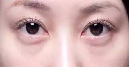 眼袋大得都能装零钱了,还不打算去掉吗?衰老、疲惫、憔悴……都是眼袋惹的祸_圈子-新氧美容整形
