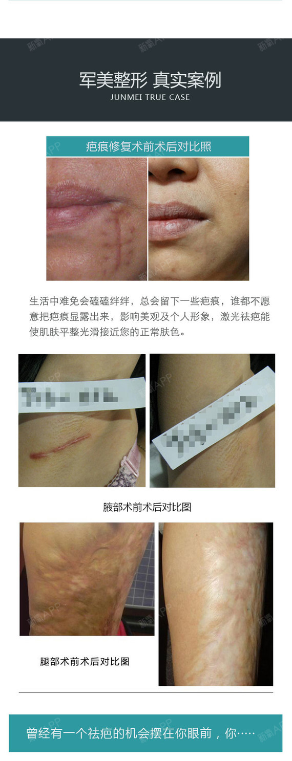【激光祛疤】公立三甲名医操作 激光无痕祛疤 修复疤痕 抚平疤痕肌肤