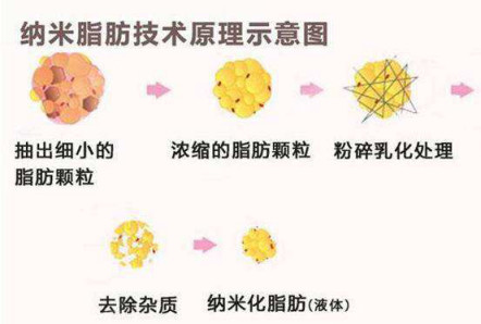 新氧 - 氧气姐 | 自体脂肪填充额头 | 自体脂肪填充太阳穴 | 自体脂肪填充全脸 | 整形纯干货 新氧 - 氧气姐 | 自体脂肪填充额头 | 自体脂肪填充太阳穴 | 自体脂肪填充全脸 | 整形纯干货