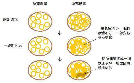 新氧 - 氧气姐 | 自体脂肪填充额头 | 自体脂肪填充太阳穴 | 自体脂肪填充全脸 | 整形纯干货 新氧 - 氧气姐 | 自体脂肪填充额头 | 自体脂肪填充太阳穴 | 自体脂肪填充全脸 | 整形纯干货