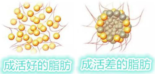 新氧 - 氧气姐 | 自体脂肪填充额头 | 自体脂肪填充太阳穴 | 自体脂肪填充全脸 | 整形纯干货 新氧 - 氧气姐 | 自体脂肪填充额头 | 自体脂肪填充太阳穴 | 自体脂肪填充全脸 | 整形纯干货