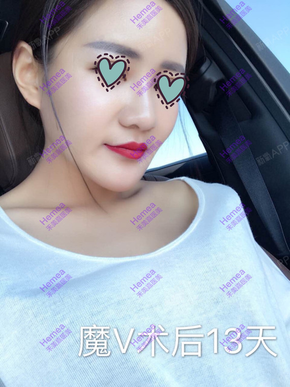【魔V钻石面部微雕】术后反馈事实证明做对了