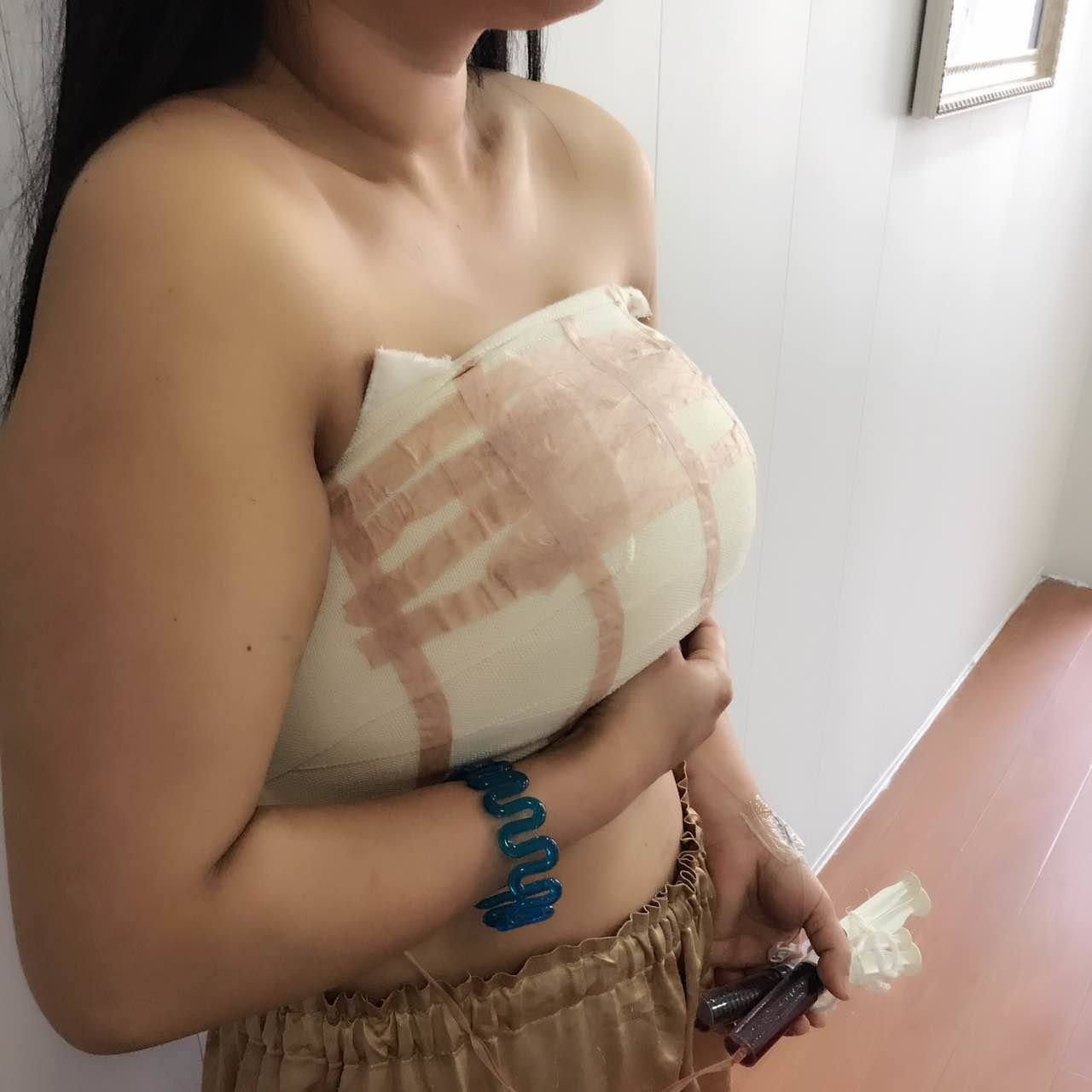 女性乳房缩小第4天