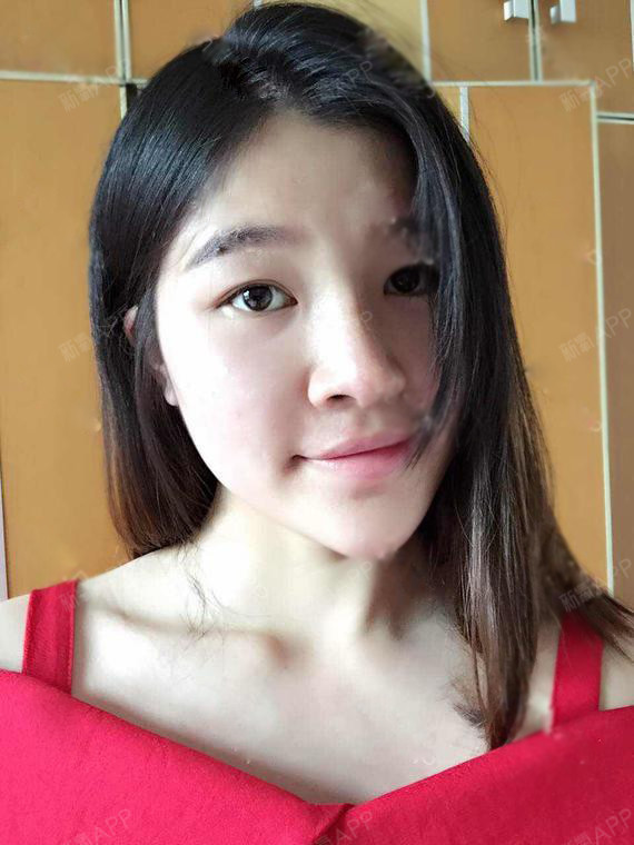 需要一杯牛奶玻尿酸垫下巴第3天美丽日记-新氧