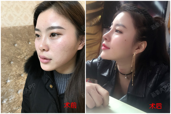 新氧 - 氧气姐 | 鼻部 | 隆鼻 | 鼻头整形 | 整形纯干货 新氧 - 氧气姐 | 鼻部 | 隆鼻 | 鼻头整形 | 整形纯干货