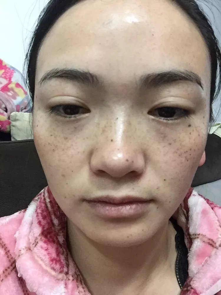 结痂脱落期光子嫩肤第  天           ·           第2篇日记