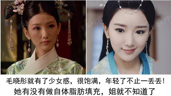 新氧 - 氧气姐 | 武松娱乐填充额头 | 武松娱乐填充太阳穴 | 武松娱乐填充全脸 | 整形纯干货 新氧 - 氧气姐 | 武松娱乐填充额头 | 武松娱乐填充太阳穴 | 武松娱乐填充全脸 | 整形纯干货
