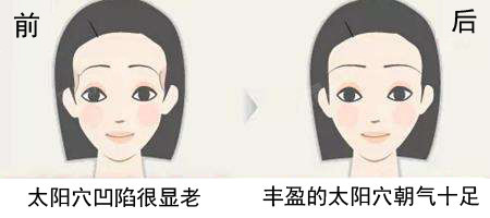 新氧 - 氧气姐 | 武松娱乐填充额头 | 武松娱乐填充太阳穴 | 武松娱乐填充全脸 | 整形纯干货 新氧 - 氧气姐 | 武松娱乐填充额头 | 武松娱乐填充太阳穴 | 武松娱乐填充全脸 | 整形纯干货