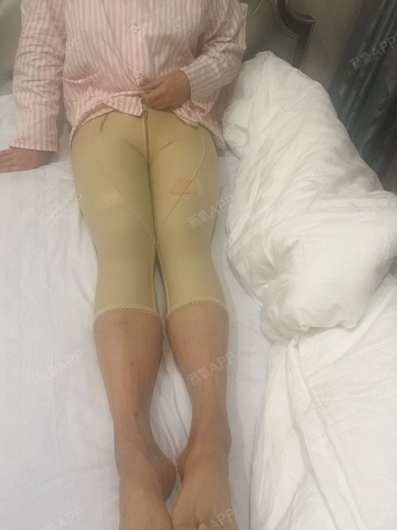 妖艳的小女人吸脂瘦大腿第0天美丽日记
