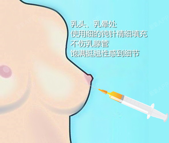 新氧 - 氧气姐 | 胸部 | 隆胸 新氧 - 氧气姐 | 胸部 | 隆胸