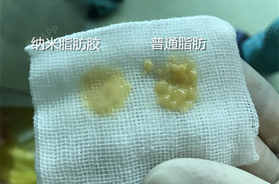 新氧 - 氧气姐 | 胸部 | 隆胸 新氧 - 氧气姐 | 胸部 | 隆胸