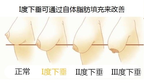 新氧 - 氧气姐 | 胸部 | 隆胸 新氧 - 氧气姐 | 胸部 | 隆胸