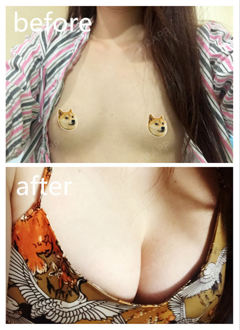 新氧 - 氧气姐 | 胸部 | 隆胸 新氧 - 氧气姐 | 胸部 | 隆胸