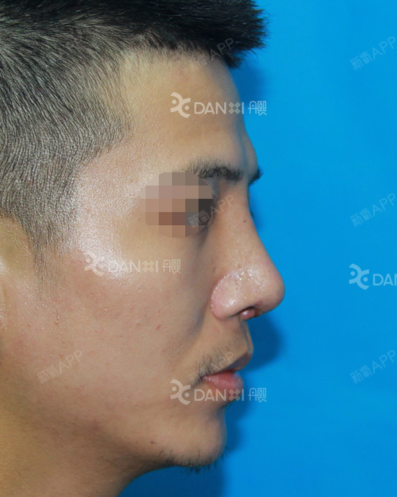 【男士鼻整形案例 术前,术后拆线】