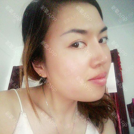 新氧-十女生间之约|肉毒素瘦脸|肉年时|术后当自强|天津同城毒素瘦腰练马甲线图片