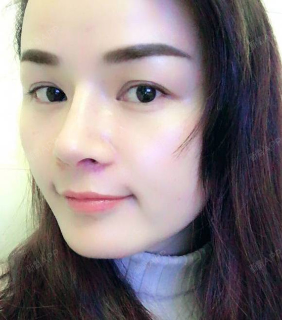 之前驼峰鼻,鼻骨有点歪 现在鼻子美得超自然