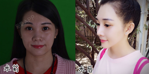 新氧 - 氧气姐 | 隆鼻 | 硅胶隆鼻 | 整形纯干货 | 鼻部综合 新氧 - 氧气姐 | 隆鼻 | 硅胶隆鼻 | 整形纯干货 | 鼻部综合