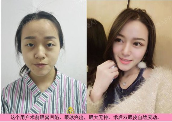 新氧 - 氧气姐 | 双眼皮 | 埋线双眼皮 | 切开双眼皮 新氧 - 氧气姐 | 双眼皮 | 埋线双眼皮 | 切开双眼皮