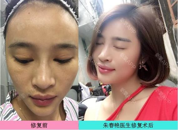 新氧 - 氧气姐 | 双眼皮 | 埋线双眼皮 | 切开双眼皮 新氧 - 氧气姐 | 双眼皮 | 埋线双眼皮 | 切开双眼皮