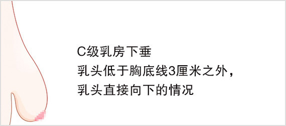 韩国原辰整形:胸部下垂程度不同有不同的手术方法.