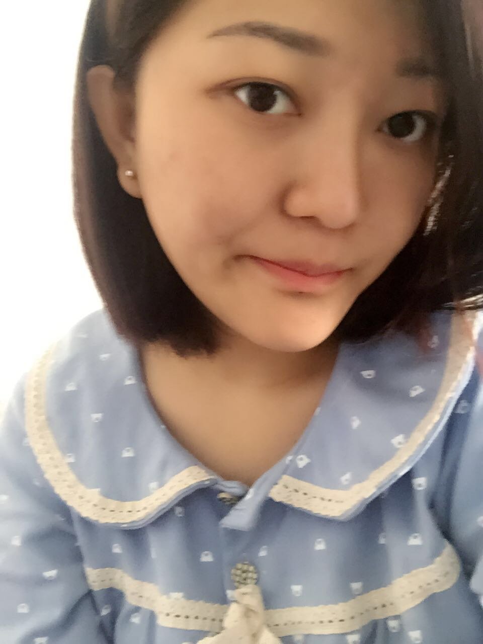【哈尔滨臻美整形】我之前的脸太平了,感觉可以用鞋拔子形容,下巴是前