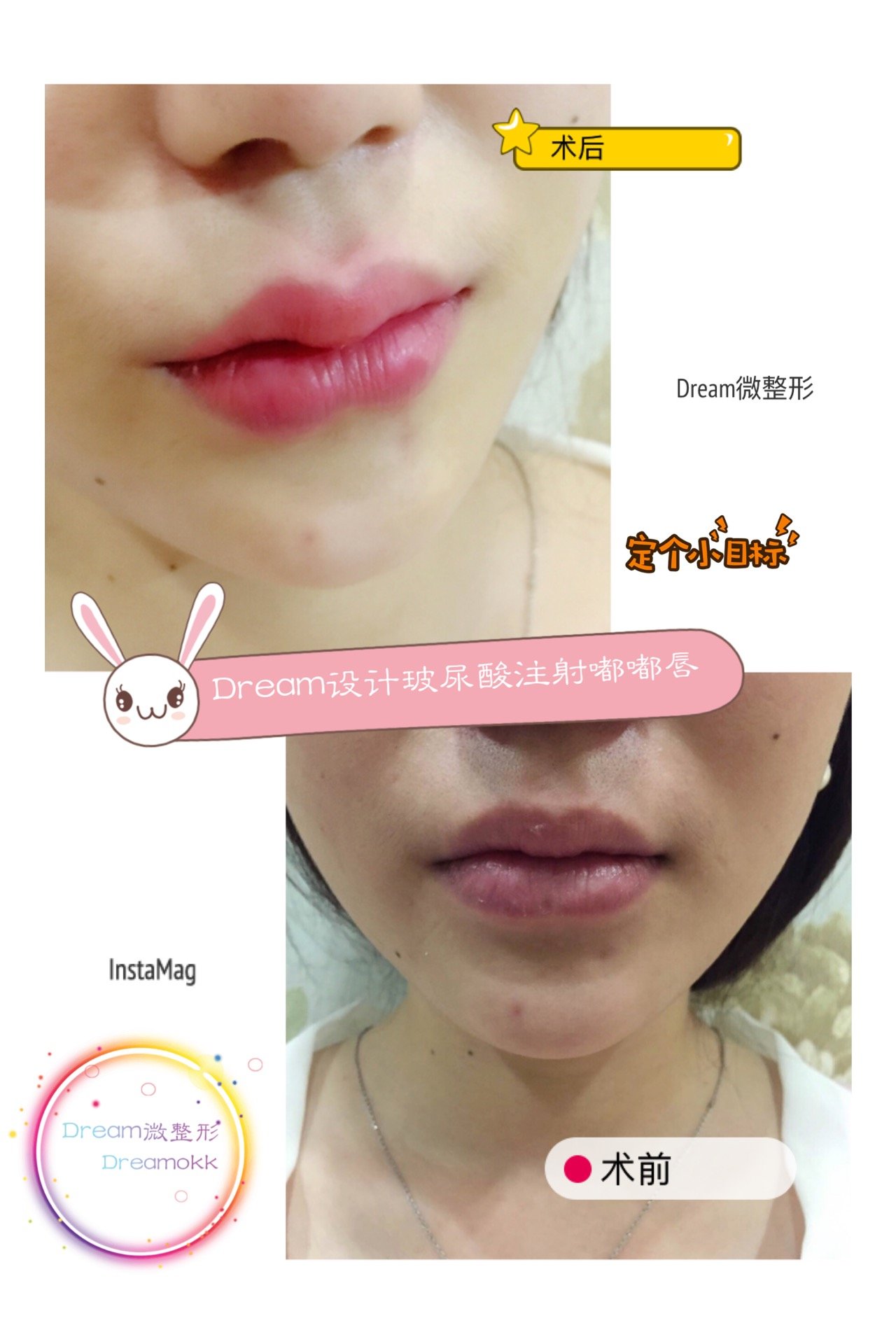 m唇手术怎么样_恢复过程_效果如何_组成凝恋7ra9整形7