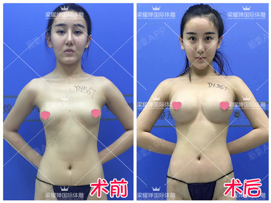 新氧 - 氧气姐 | 胸部 | 武松娱乐隆胸 | 整形纯干货 | 名医直通车 新氧 - 氧气姐 | 胸部 | 武松娱乐隆胸 | 整形纯干货 | 名医直通车