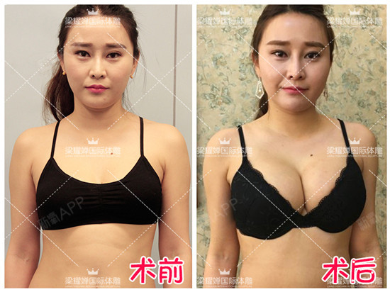 新氧 - 氧气姐 | 胸部 | 武松娱乐隆胸 | 整形纯干货 | 名医直通车 新氧 - 氧气姐 | 胸部 | 武松娱乐隆胸 | 整形纯干货 | 名医直通车
