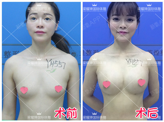 新氧 - 氧气姐 | 胸部 | 武松娱乐隆胸 | 整形纯干货 | 名医直通车 新氧 - 氧气姐 | 胸部 | 武松娱乐隆胸 | 整形纯干货 | 名医直通车