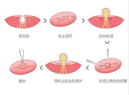 韩国原辰整形:韩国乳头凹陷手术方法.