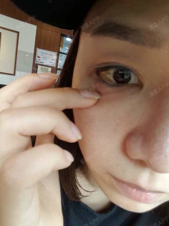 虽然只做了外眼角和下至但是眼睛变得真的很大,之前眼_圈子-新氧美容