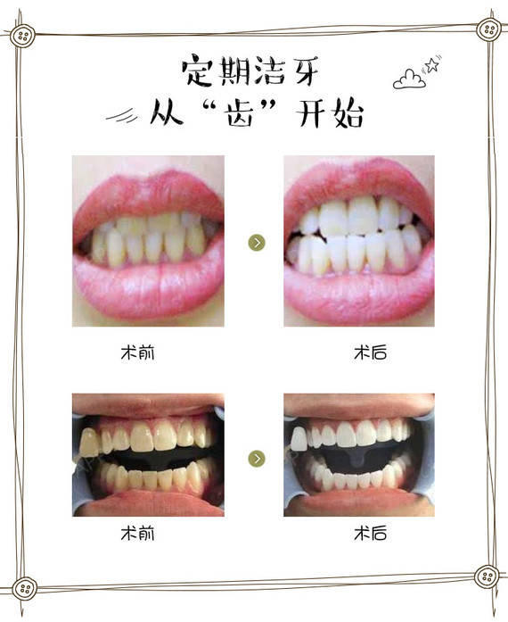 【超声波洗牙】超声波洁牙 无痛洗牙 去除烟渍,茶渍,色素 保护牙齿