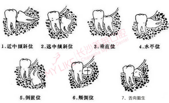 智齿阻生的原因在青春后期