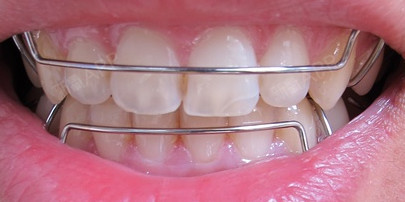 患者正畸治疗结束摘掉牙套之后,医生会制作一付保持器供患_圈子-新氧