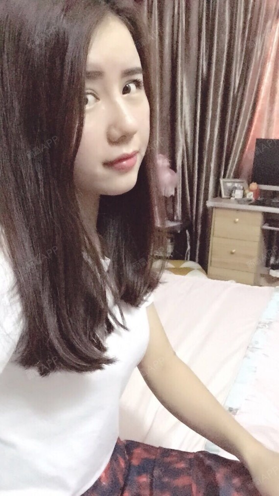 mm大虾米自体脂肪全脸填充第102天美丽日记