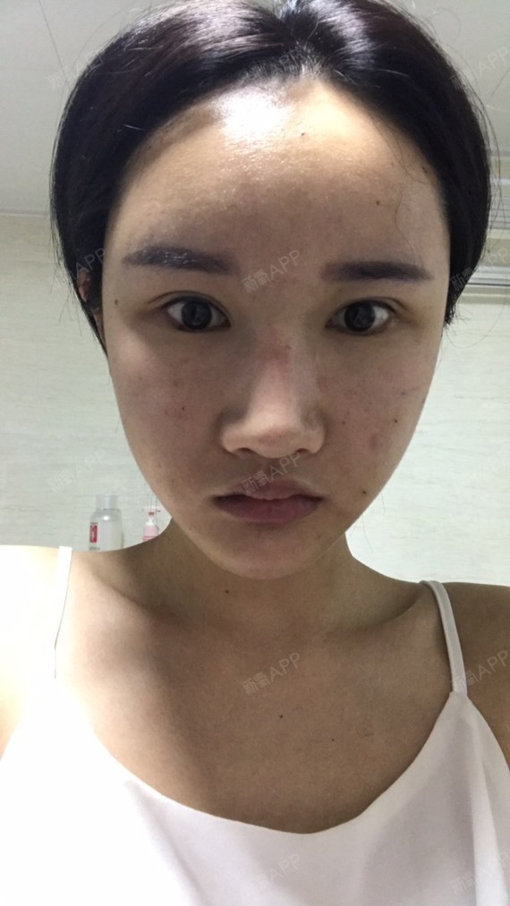 李纪梵希希自体脂肪填充全脸第3天美丽日记-新