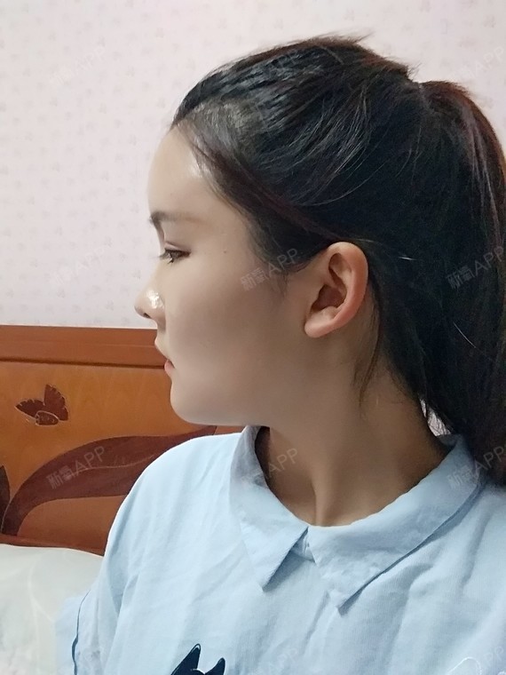 阁楼里的小花F自体脂肪全脸填充第14天美丽日