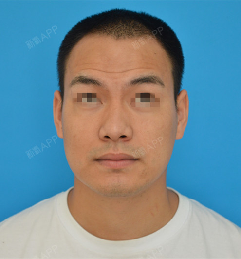 终于有时间来万安做了除皱针,看新氧价格999的