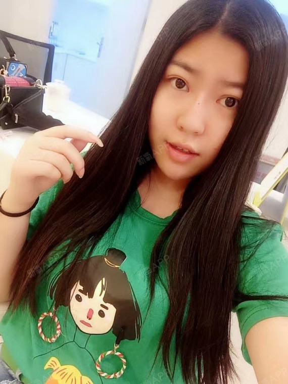 人生不能丑切开双眼皮第14天美丽日记