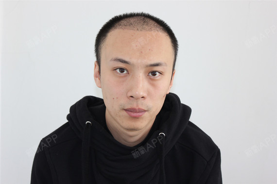 深圳鹏程医院(植发科)种植头顶毛发第32天美丽